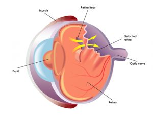 Retina Detachment | Burlington County Eye Physicians