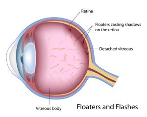 Flashes and Floaters Signs of PVD | Posterior Vitreous Detachment
