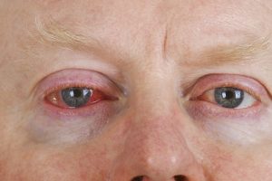 What is Pink Eye? | Burlington County Eye Physicians
