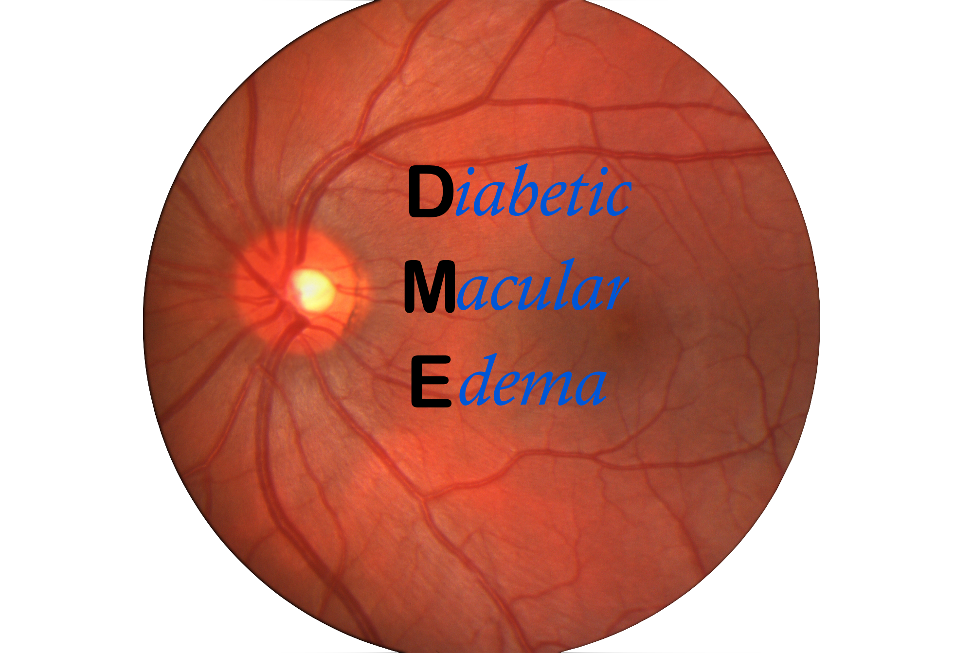 diabetic macular edema)