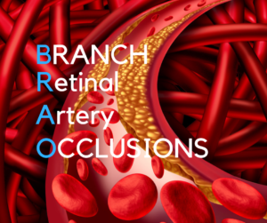 BRAO | Branch Retinal Artery Occlusions