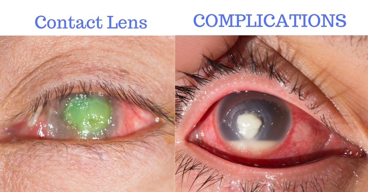 specificeren Moeras Bewusteloos Complications of Contact Lenses - Board Certified Eye Doctors | Burlington  Bucks County Millville