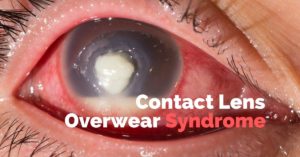 Contact Lens Overwear Featured Image