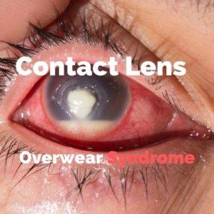 Contact Lens Overwear with Corneal Ulcer