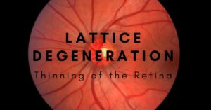 Lattice Degeneration | The Eye Professionals