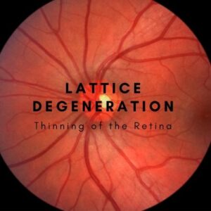 Featured text image for The Eye Professionals | What is Lattice Degeneration?