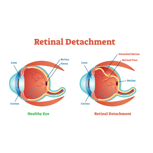 Retinal Detachment | Article Featured Image
