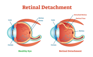 Featured Image Surgery for Retinal Detachment