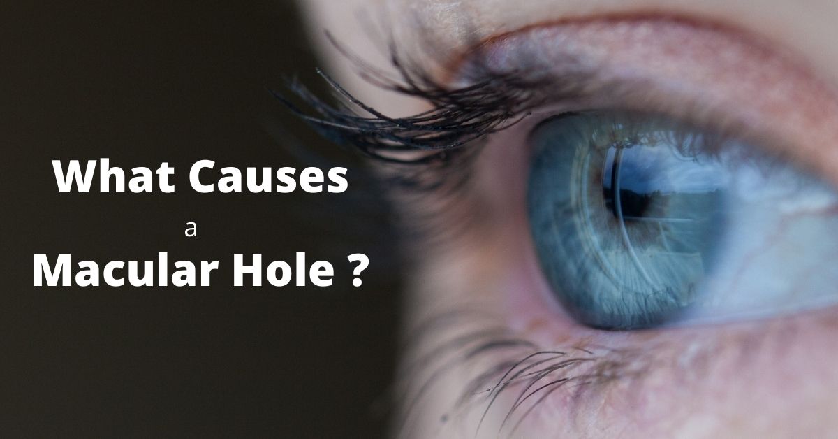 Macular Holes: How They Are Caused and Treated