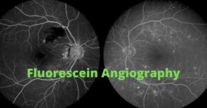Featured Image Fluorescein Angiography