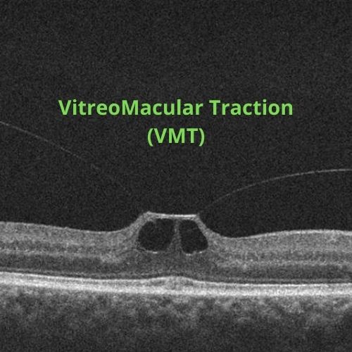 Main Article Image | OCT of VMT