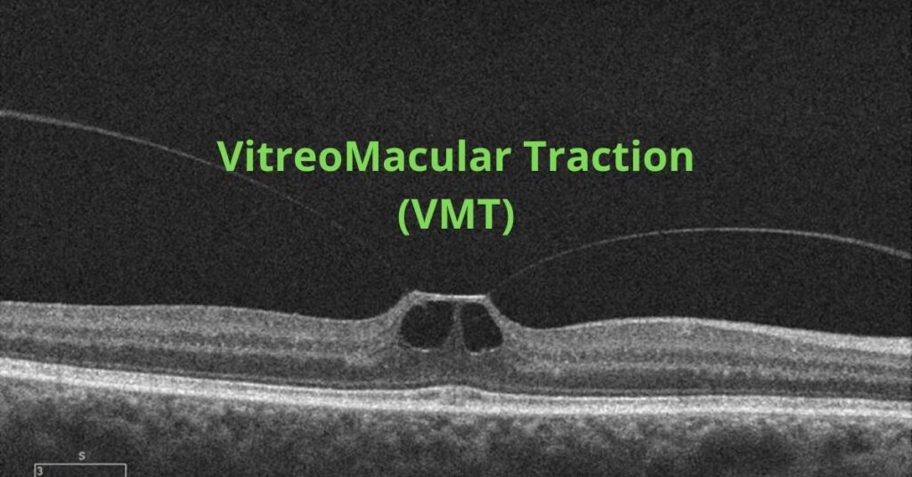 Featured Image VMT