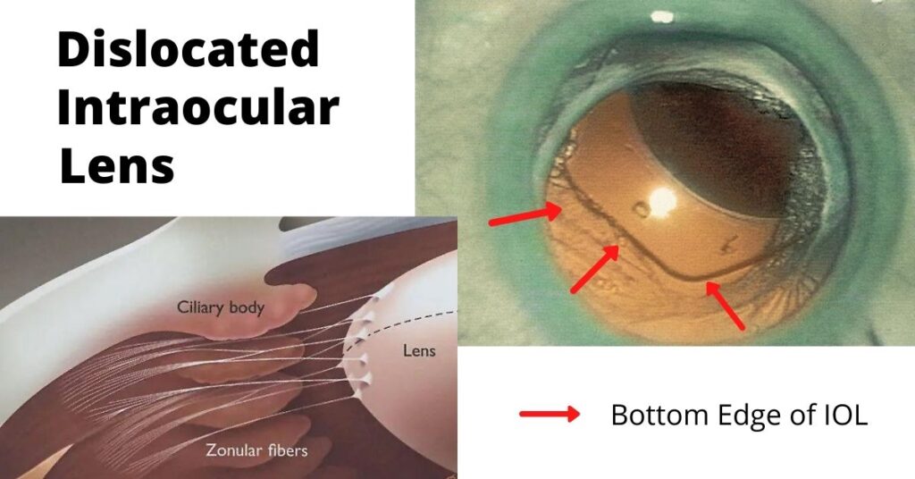 Featured Image Dislocated Intraocular Lens