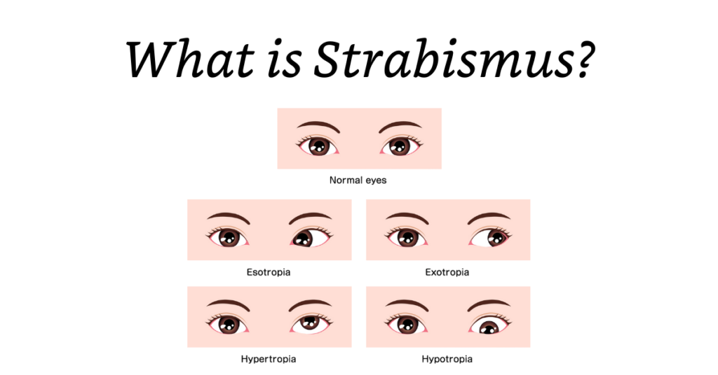 Featured Image Strabismus