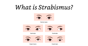 Featured Image Strabismus