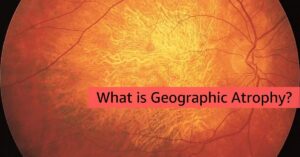 Geographic Atrophy Featured Image