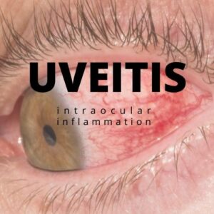 Article Image for Uveitis