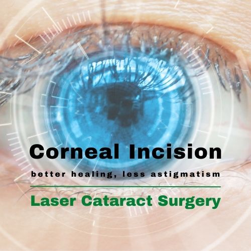 Article Image Corneal Incision Laser Cataract