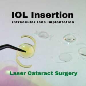 Article Image Lens IOL Insertion
