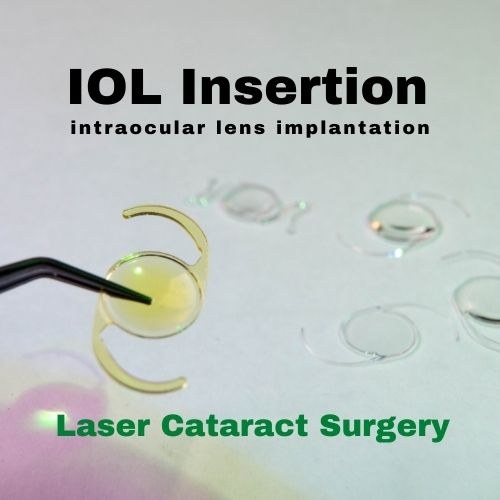 Article Image Lens IOL Insertion