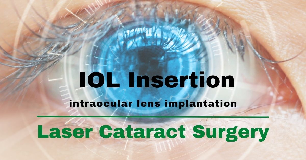 What Is an Intraocular Lens Implant (IOL)?