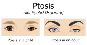 Ptosis Featured Image