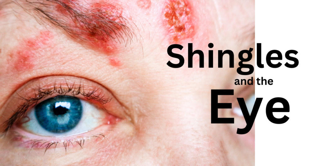 Featured article image shingles in the eye