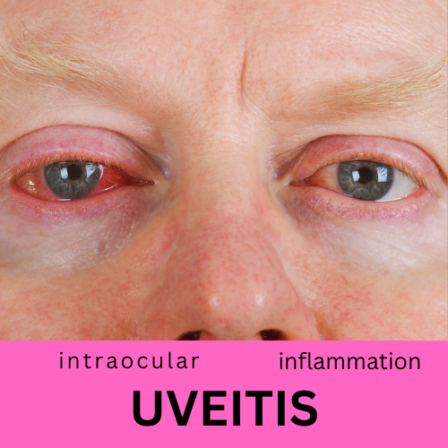 Iris and Uvea of the Eye - All About Vision