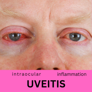 Article image for Uveitis