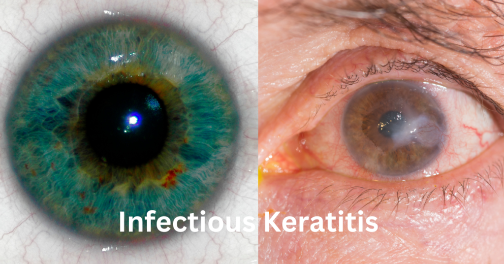 Featured image for infectious keratitis