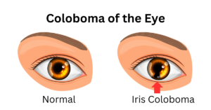 Featured Image of Coloboma of the Eye