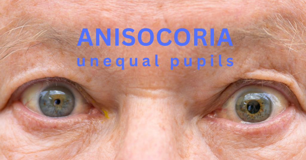 Featured Article Image for Anisocoria