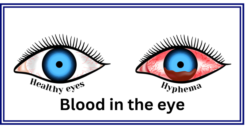 Blood in the eye is a hyphema