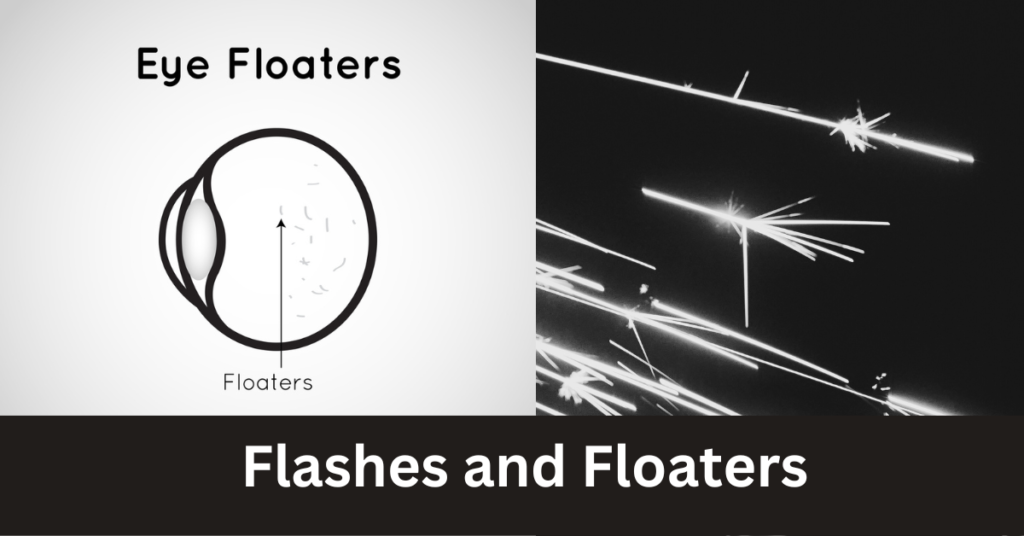 Featured article image flashes and floaters