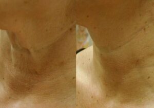 BA ClearLift Neck2